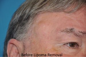 Mass Removal