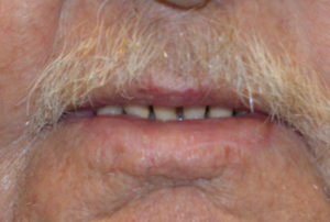 Skin Cancer Reconstruction