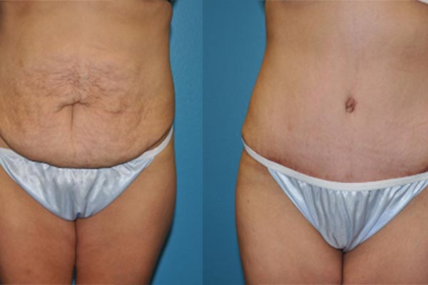 Abdominoplasty