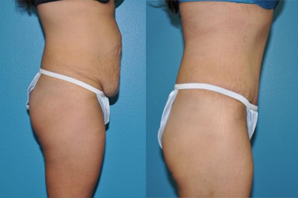 Abdominoplasty