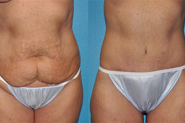 Abdominoplasty