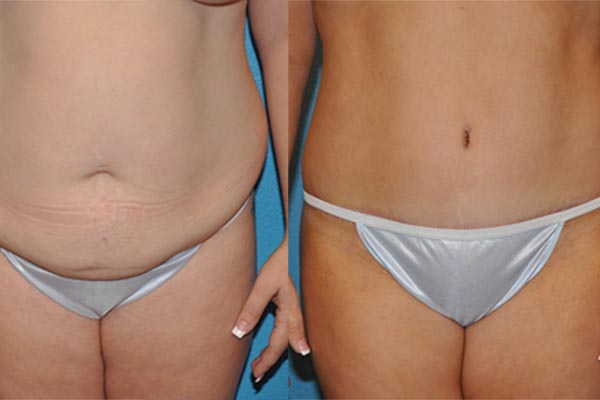 Abdominoplasty