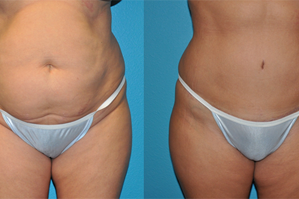 Abdominoplasty