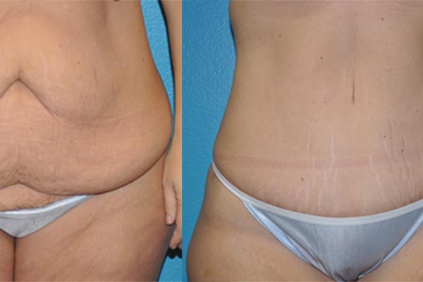 Abdominoplasty