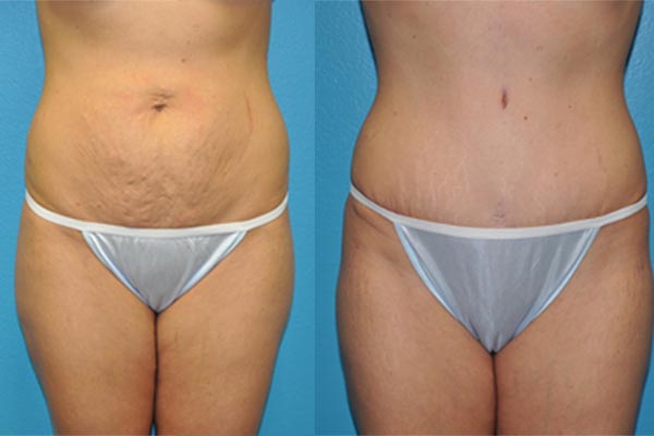 Abdominoplasty