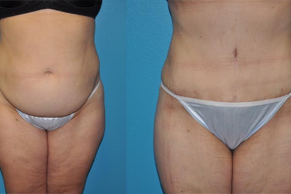 Abdominoplasty