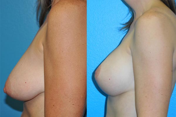 Augmentation Mastopexy