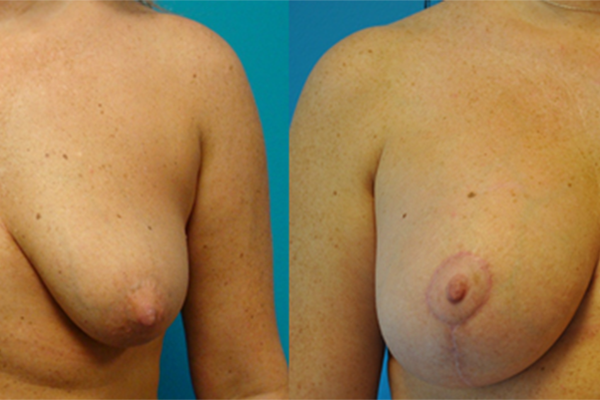 Augmentation Mastopexy