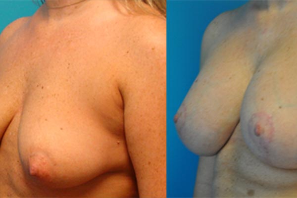 Augmentation Mastopexy