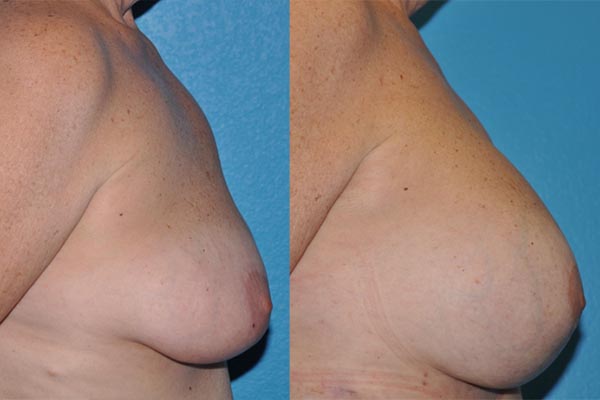 Augmentation Mastopexy