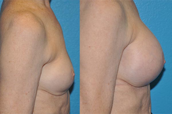 Augmentation Mastopexy