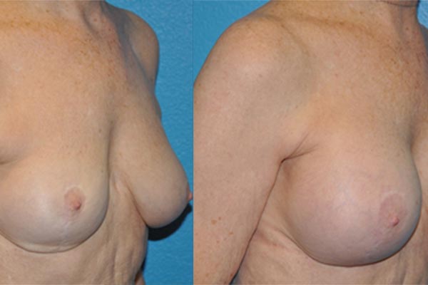 Augmentation Mastopexy