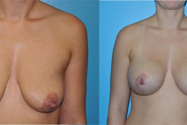 Augmentation Mastopexy