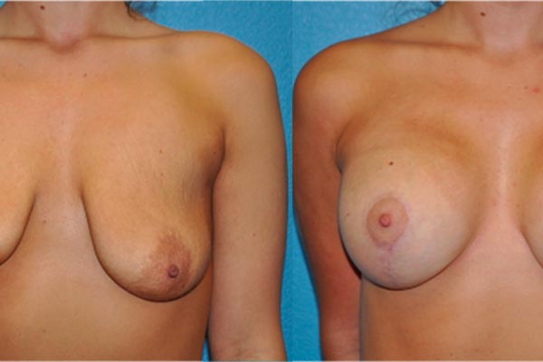 Breast Asymmetry