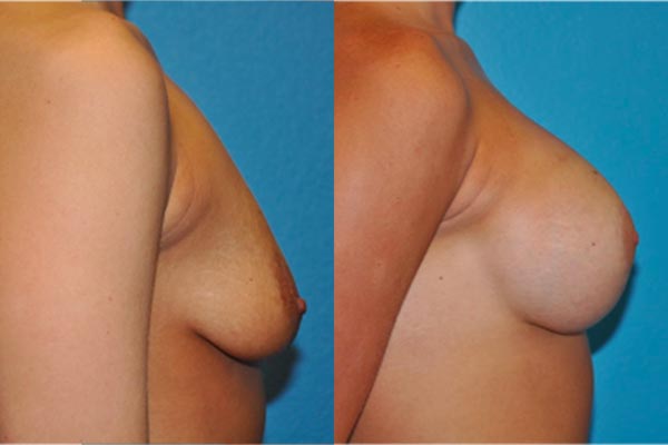 Breast Asymmetry