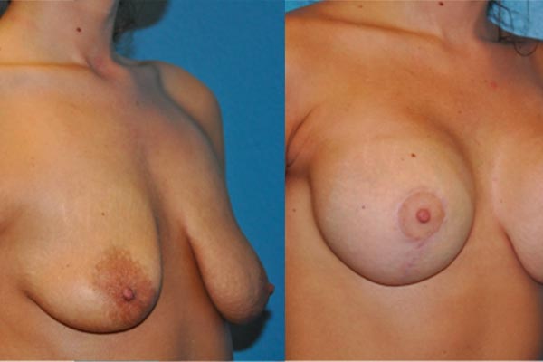 Breast Asymmetry