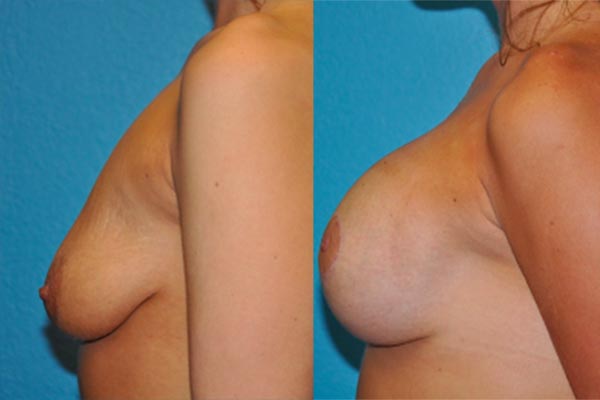 Breast Asymmetry