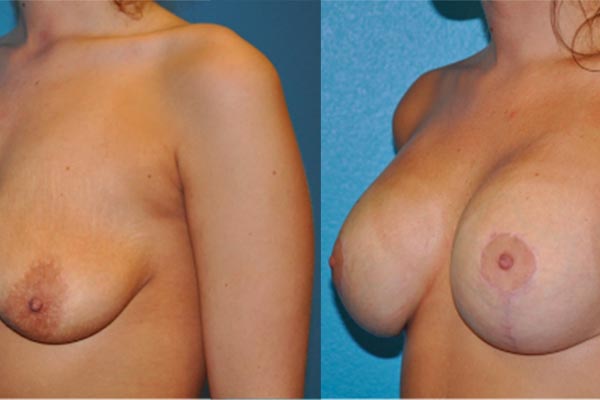 Breast Asymmetry