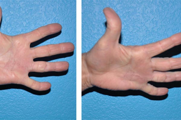 Dupuytren's Contracture