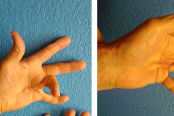 Dupuytren's Contracture