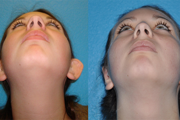 Prominent Ears/Otoplasty