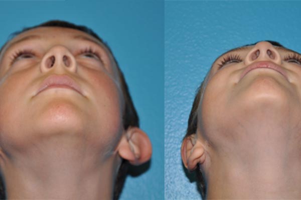 Prominent Ears/Otoplasty