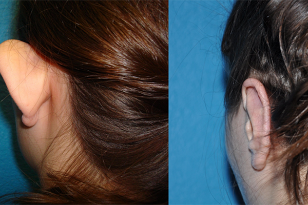 Prominent Ears/Otoplasty