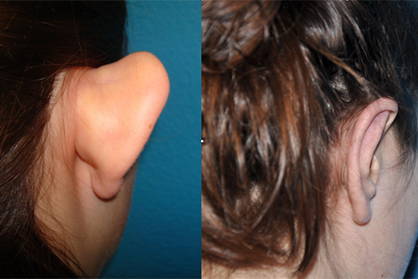 Prominent Ears/Otoplasty