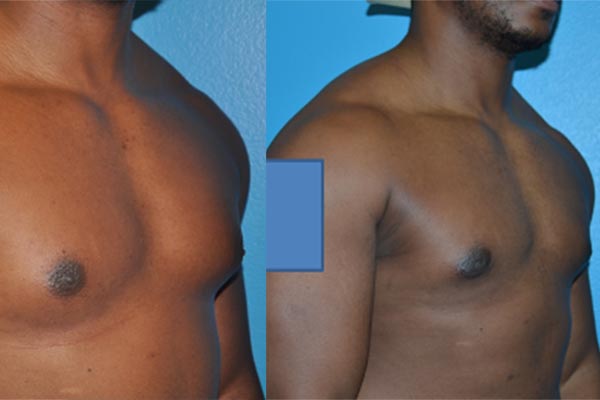 Gynecomastia