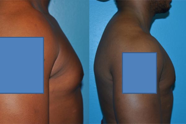 Gynecomastia