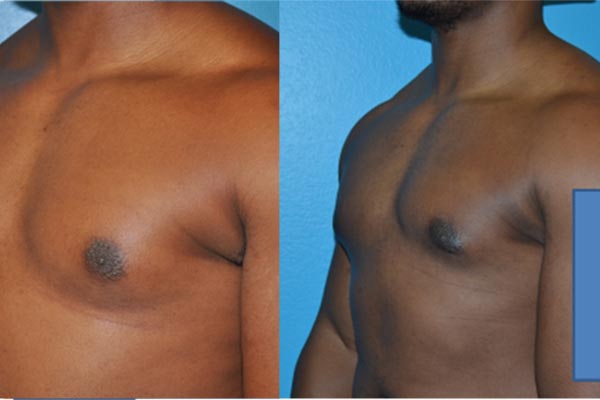 Gynecomastia