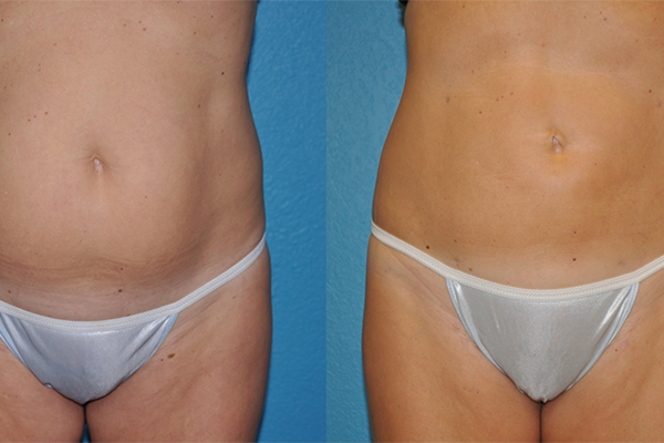 Liposuction