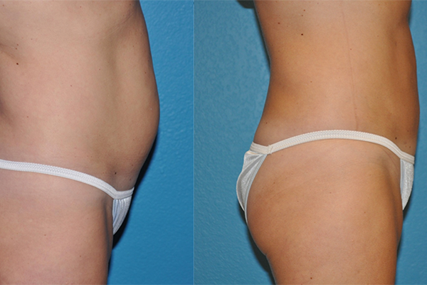 Liposuction