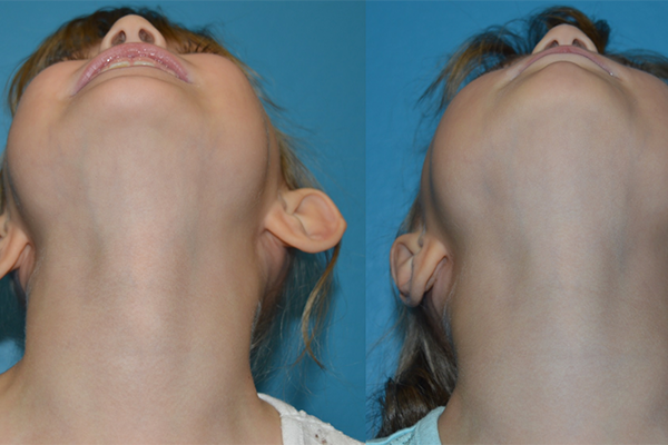 Prominent Ears/Otoplasty