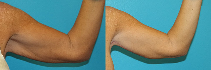 arm lift before and after images