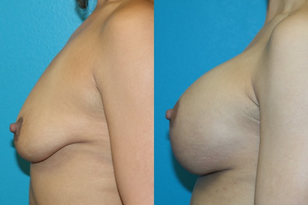 Augmentation Mastopexy
