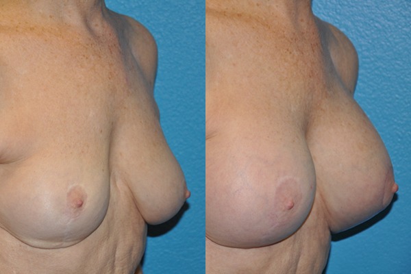 Augmentation Mastopexy