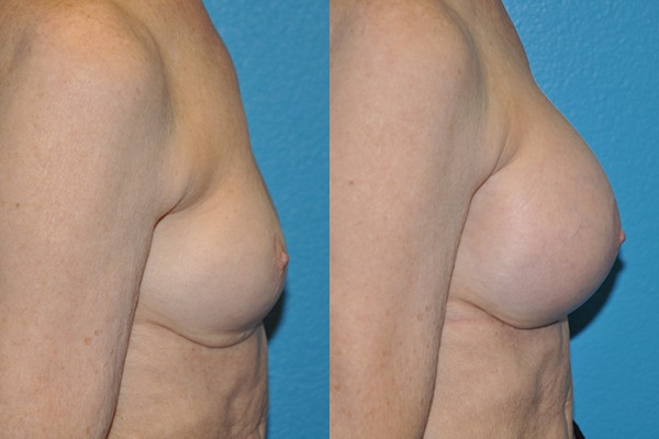 Augmentation Mastopexy