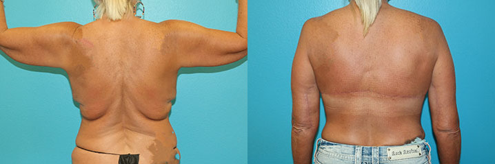 body lift before and after images
