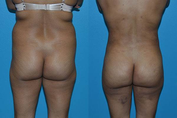 Brazilian Butt Lift