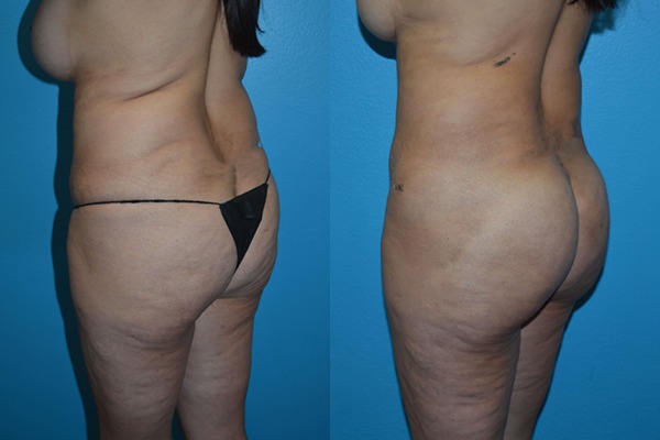 Brazilian Butt Lift