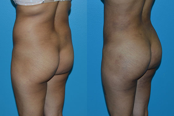 Brazilian Butt Lift