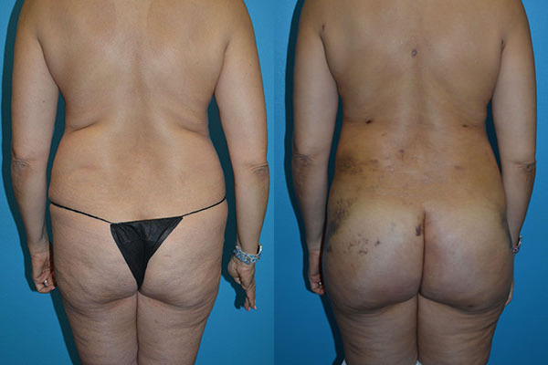 Brazilian Butt Lift