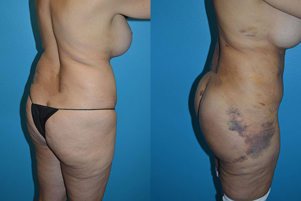 Brazilian Butt Lift