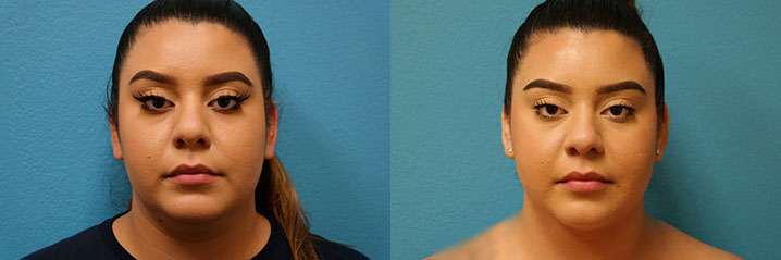 facetite before and after images