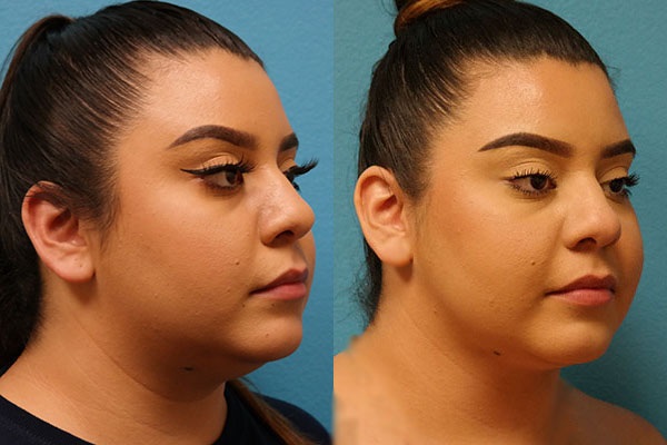 FaceTite/BodyTite