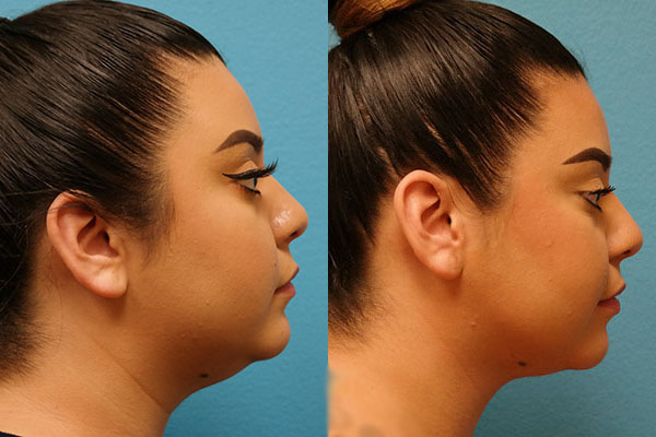 FaceTite/BodyTite