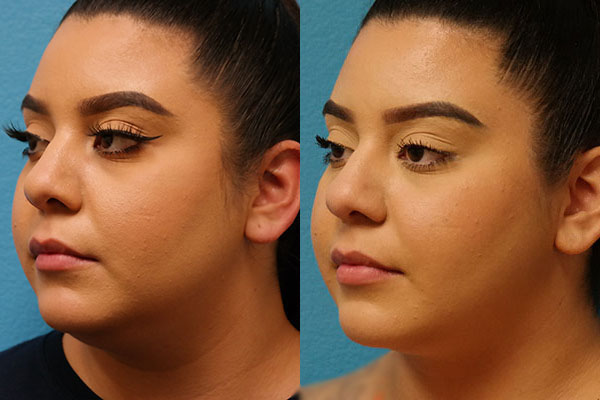 FaceTite/BodyTite