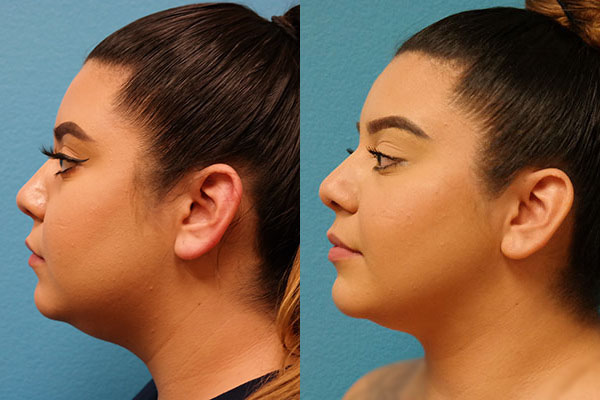 FaceTite/BodyTite