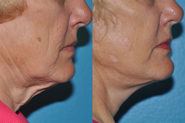Facelift